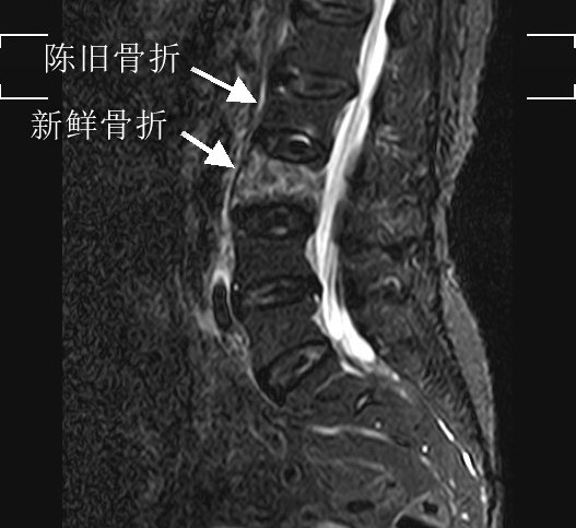 椎体压缩性骨折分度图图片